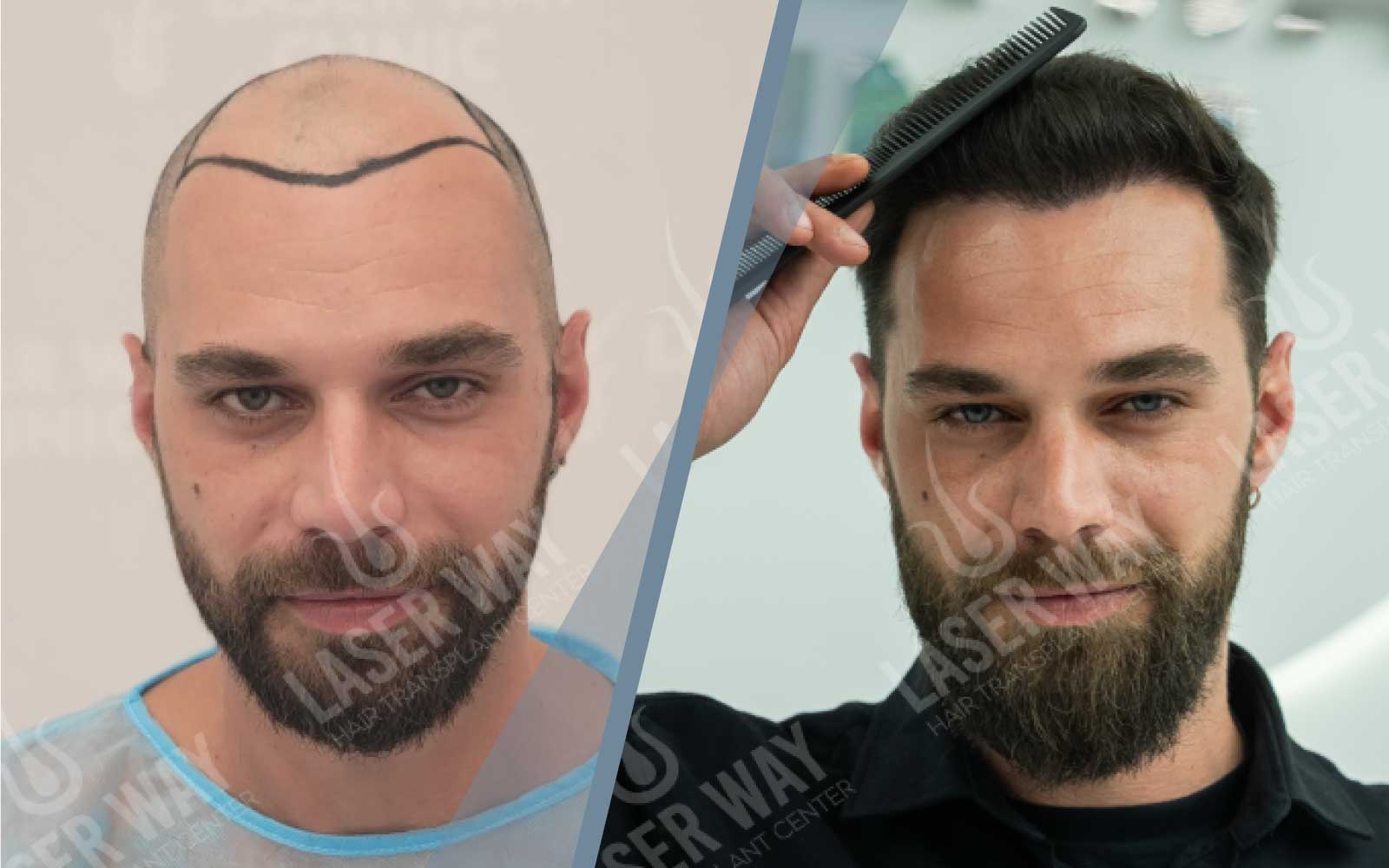 para dhe pas mbjelljes se flokeve ne Laser Way