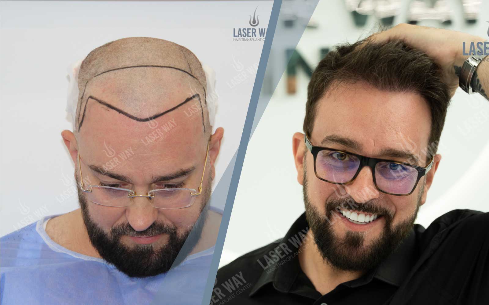 How Much Downtime Do You Need After a Hair Transplant