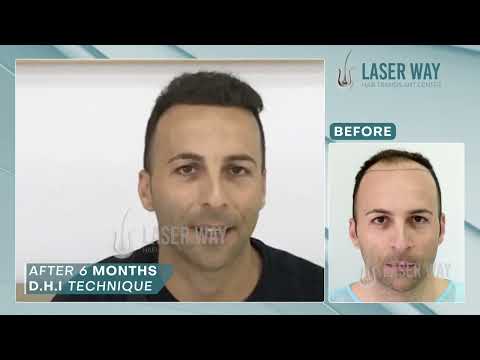 Testimonianza paziente Laser Way 4