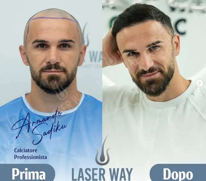 Trapianto capelli Albania prima e dopo: risultati da 1 a 12 mesi